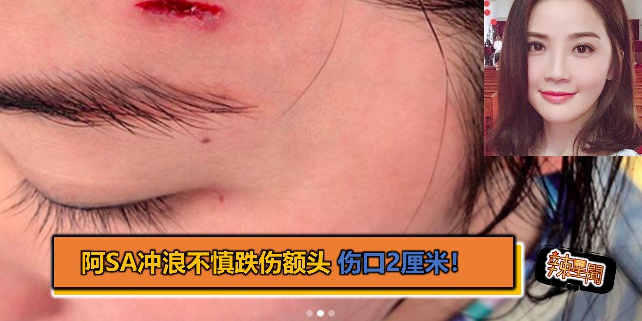 阿sa冲浪不慎跌伤额头 伤口2厘米！