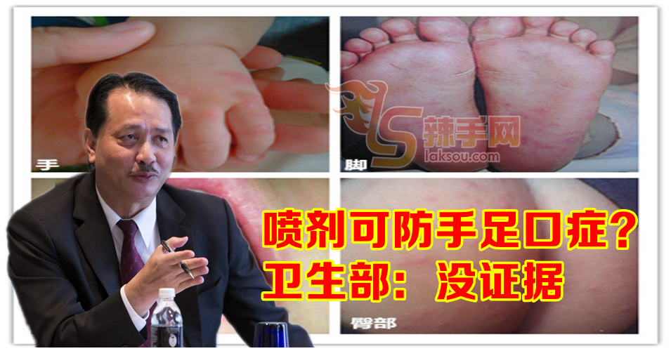 喷剂可防手足口症？ 卫生部：没证据证明有效