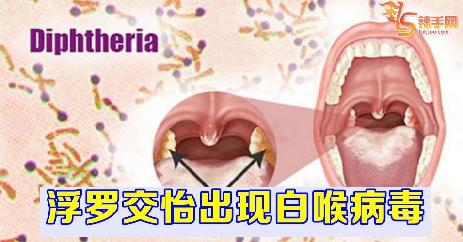 浮罗交怡出现白喉病毒