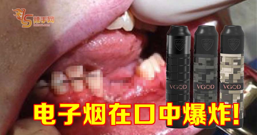 电子烟在口中爆炸 少年牙齿被炸掉