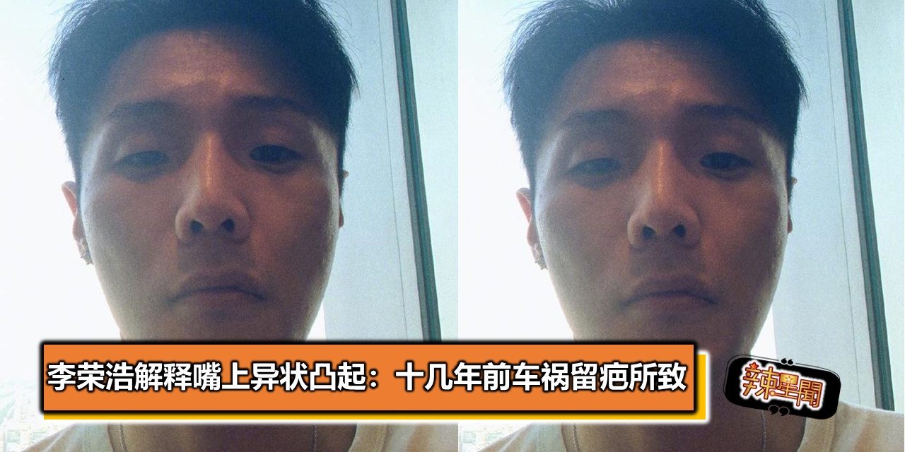 李荣浩解释嘴上异状凸起：十几年前车祸留疤所致