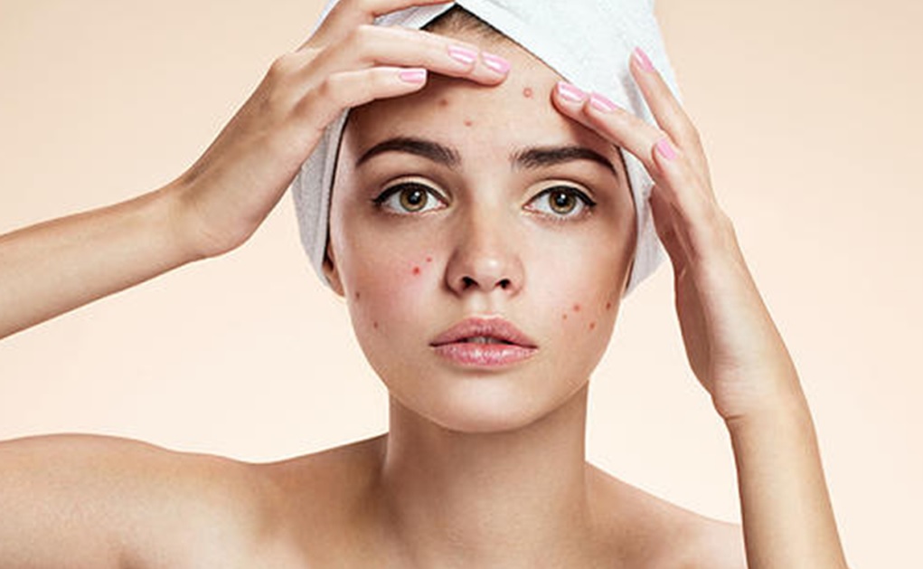 超全祛痘攻略！起痘痘的妹纸一定要仔细看