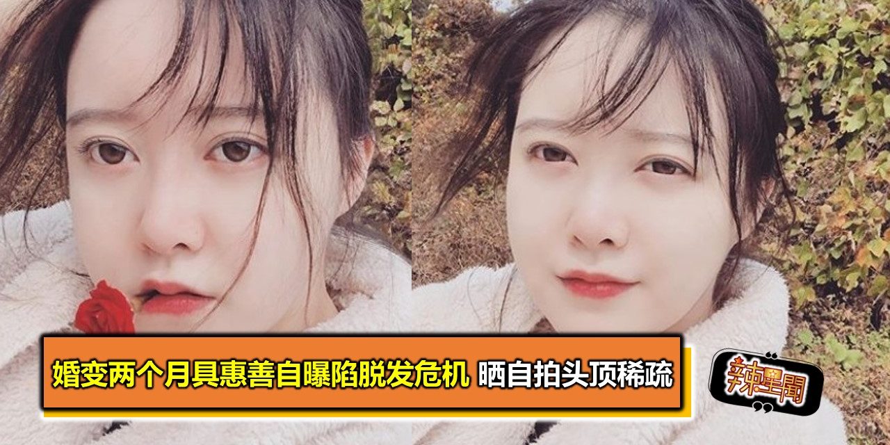 婚变两个月具惠善自曝陷脱发危机 晒自拍头顶稀疏