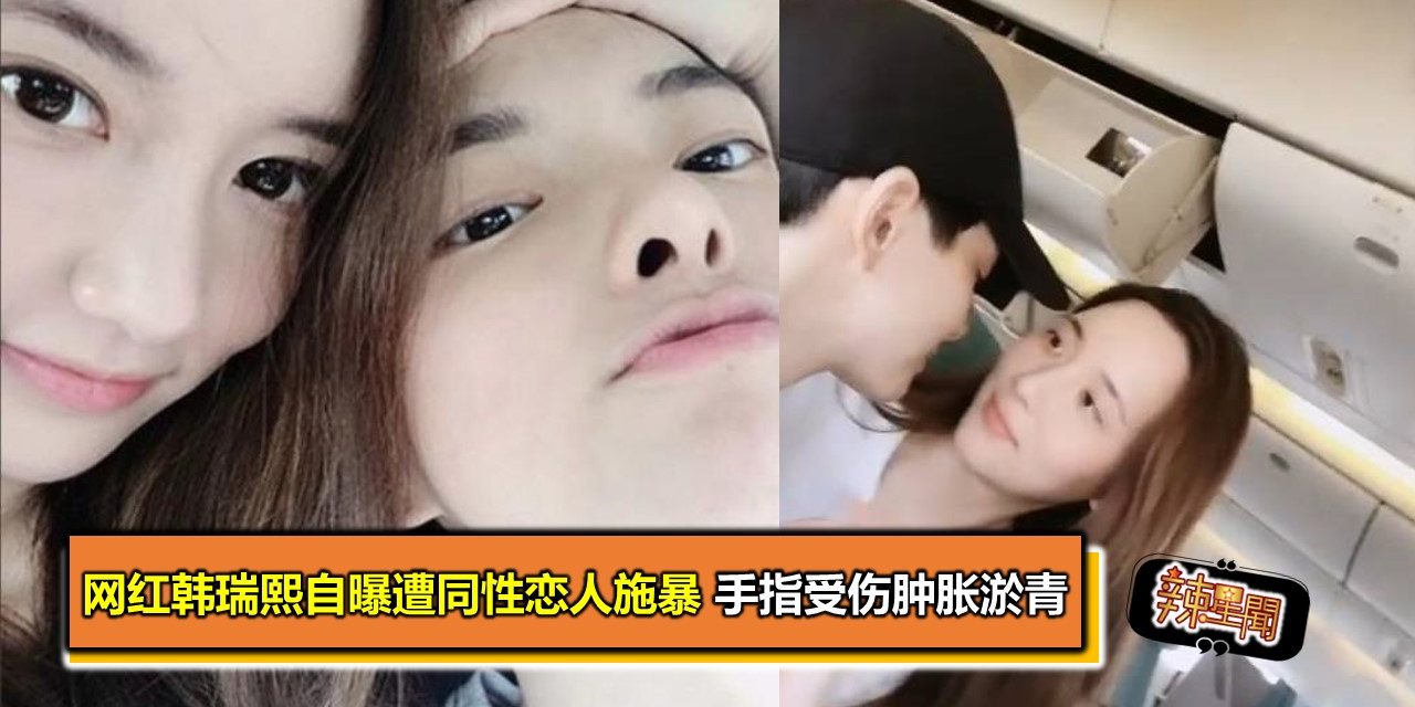 网红韩瑞熙自曝遭同性恋人施暴 手指受伤肿胀淤青