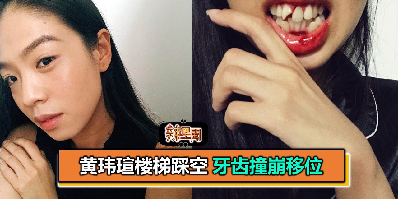 黄玮瑄楼梯踩空 牙齿撞崩移位