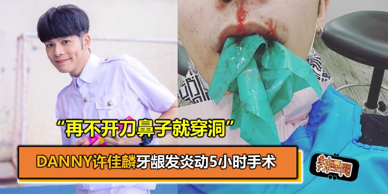 Danny许佳麟牙龈发炎动5小时手术“再不开刀鼻子就穿洞”
