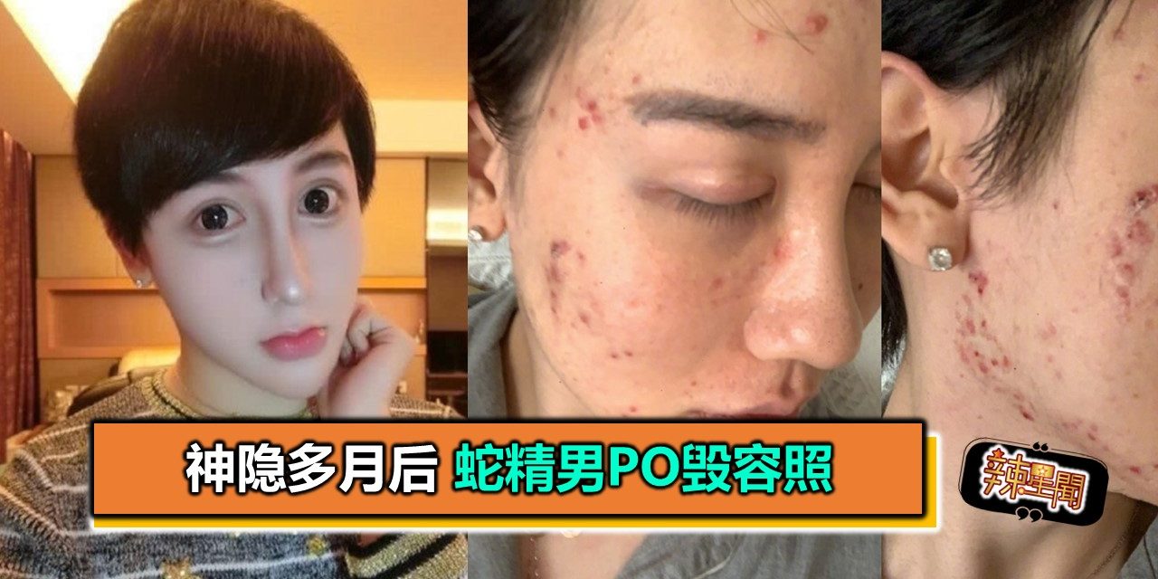 神隐多月后 蛇精男PO毁容照