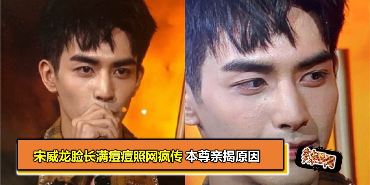 宋威龙脸长满痘痘照网疯传 本尊亲揭原因