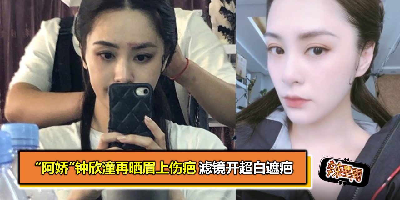 “阿娇”钟欣潼再晒眉上伤疤 滤镜开超白遮疤