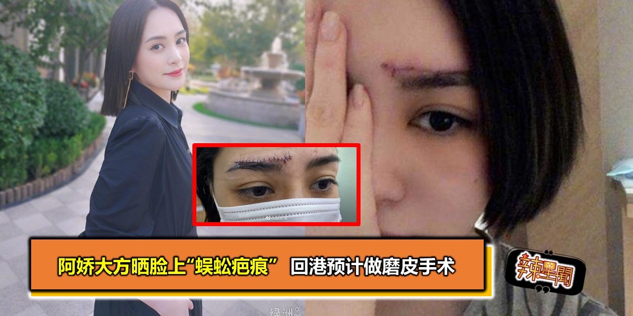 阿娇大方晒脸上“蜈蚣疤痕”  回港预计做磨皮手术