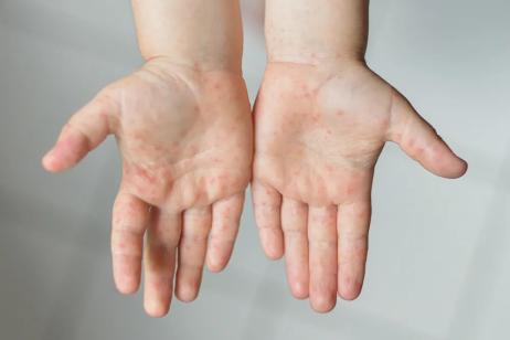 雪州手足口症爆增 家长们最好这样做